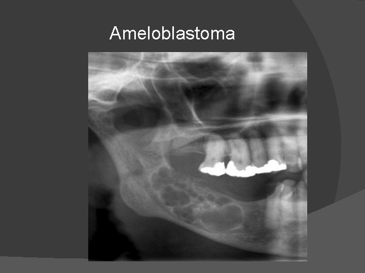 Ameloblastoma 