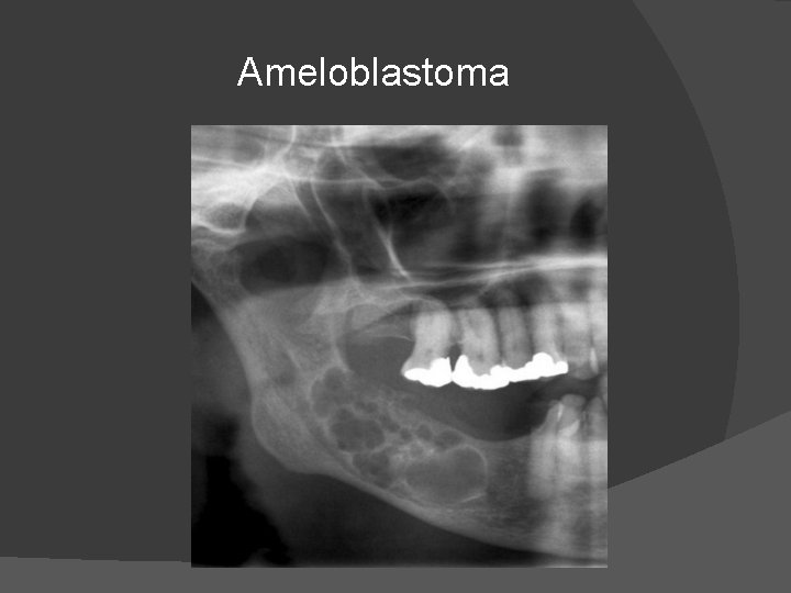 Ameloblastoma 