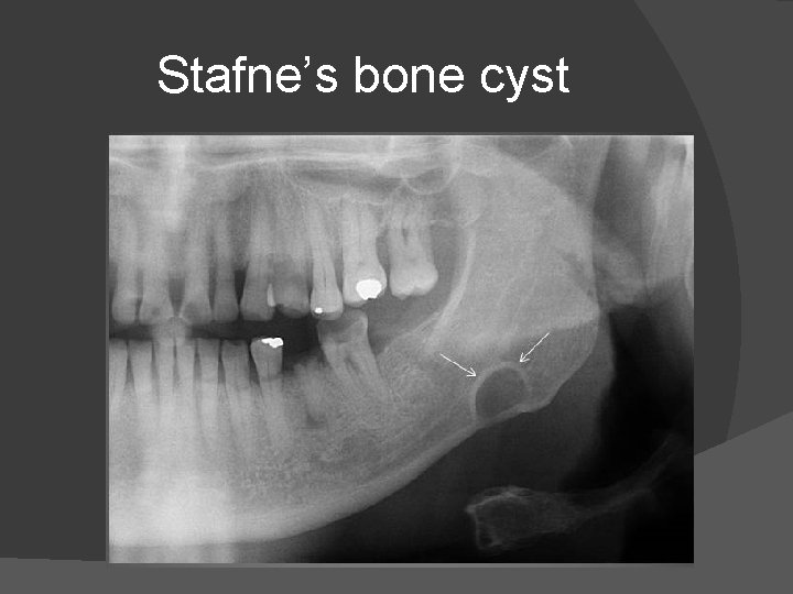 Stafne’s bone cyst 