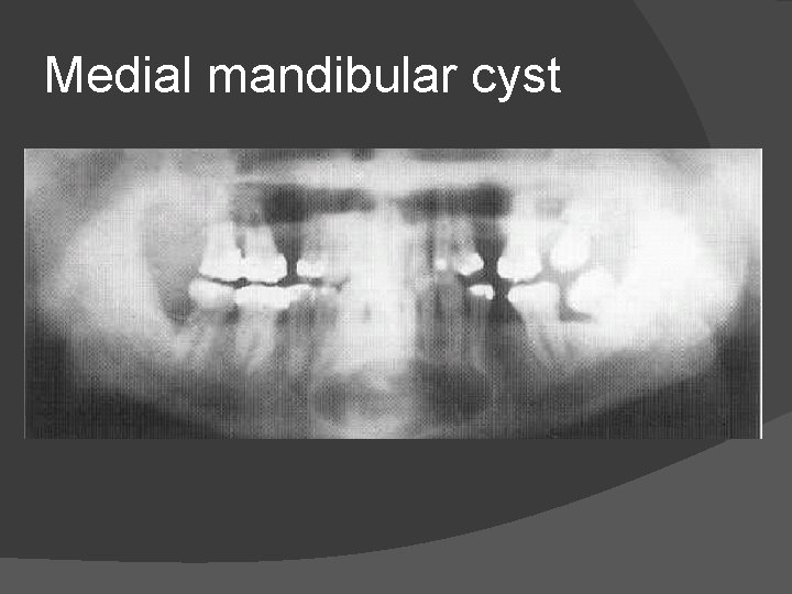 Medial mandibular cyst 