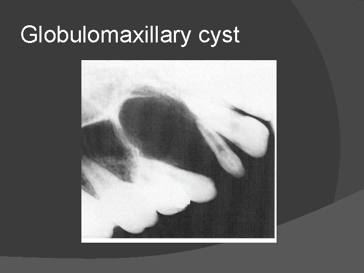 Globulomaxillary cyst 