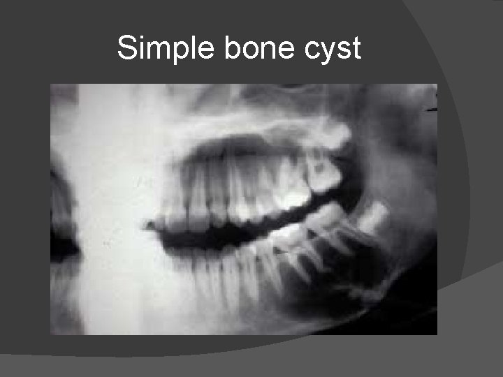 Simple bone cyst 