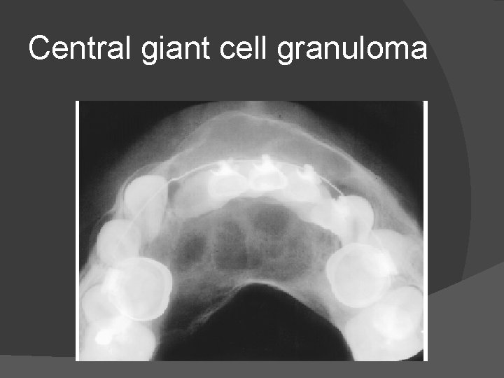 Central giant cell granuloma 