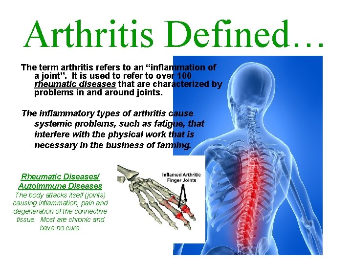 Arthritis Defined… The term arthritis refers to an “inflammation of a joint”. It is