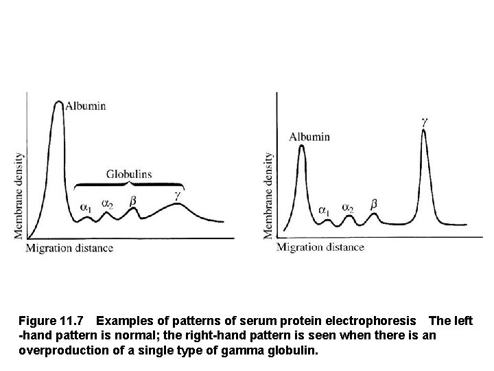 Figure 11. 7 Examples of patterns of serum protein electrophoresis The left -hand pattern
