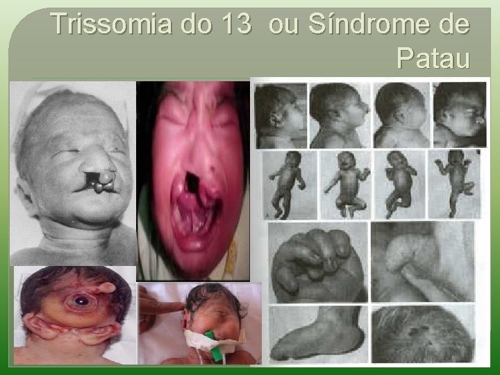 Trissomia do 13 ou Síndrome de Patau 