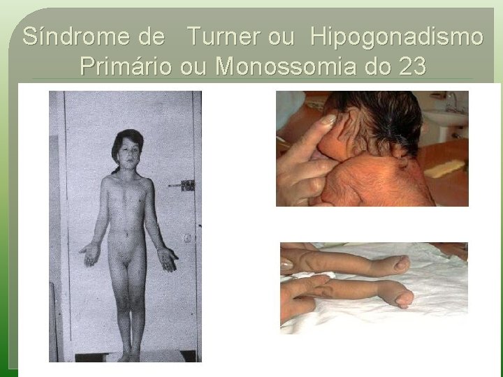 Síndrome de Turner ou Hipogonadismo Primário ou Monossomia do 23 