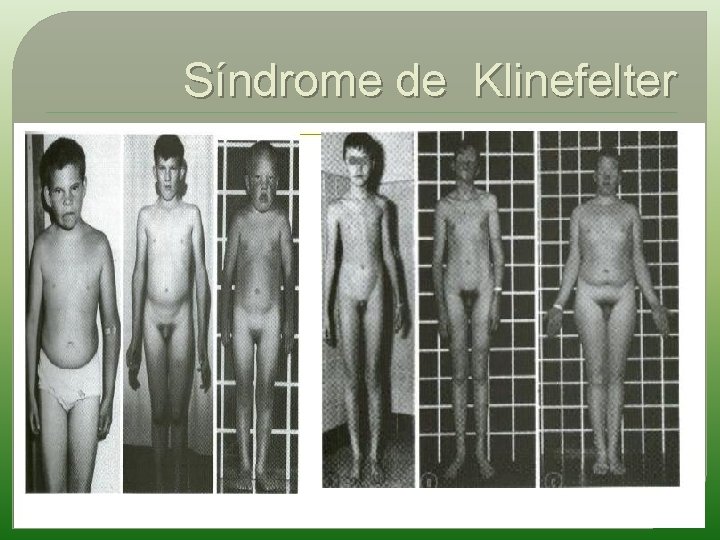 Síndrome de Klinefelter 