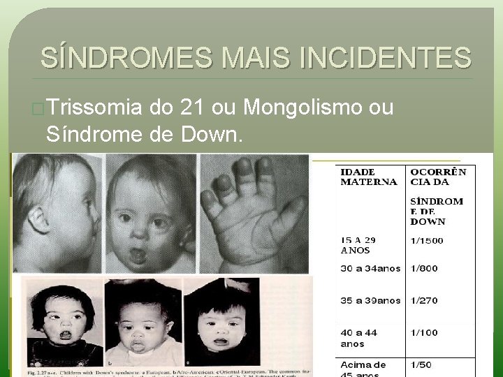 SÍNDROMES MAIS INCIDENTES �Trissomia do 21 ou Mongolismo ou Síndrome de Down. 