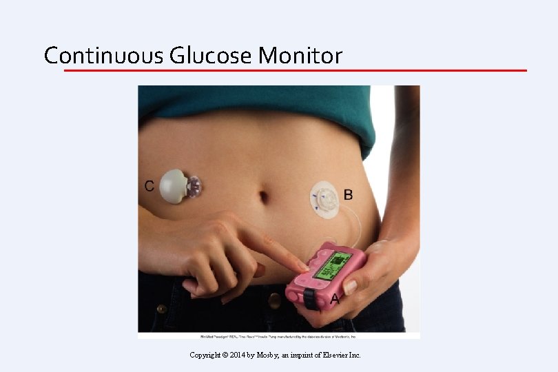 Continuous Glucose Monitor Copyright © 2014 by Mosby, an imprint of Elsevier Inc. 