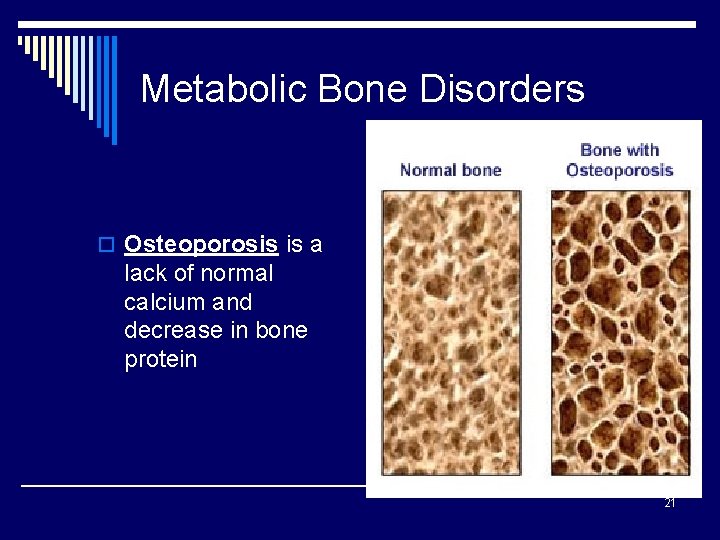 Metabolic Bone Disorders o Osteoporosis is a lack of normal calcium and decrease in