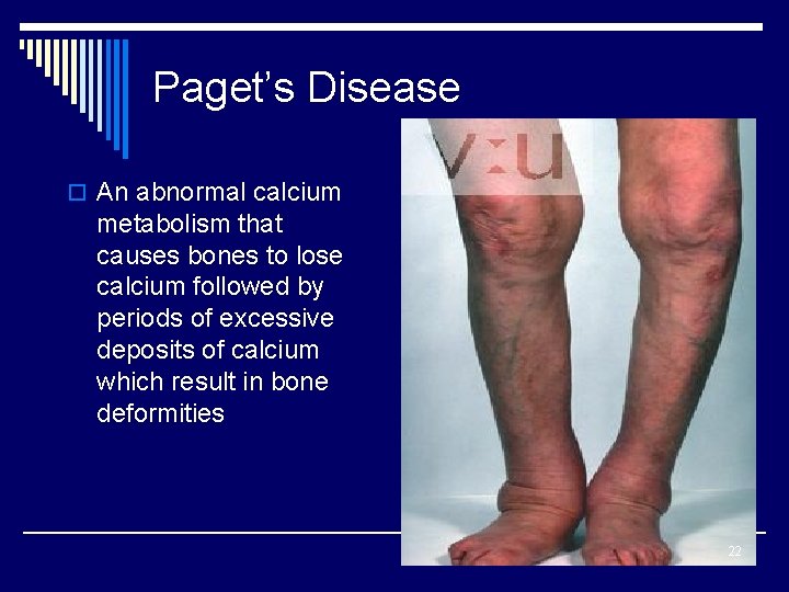 Paget’s Disease o An abnormal calcium metabolism that causes bones to lose calcium followed