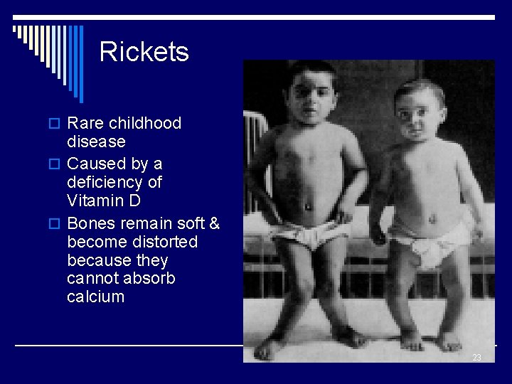 Rickets o Rare childhood disease o Caused by a deficiency of Vitamin D o