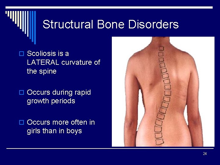 Structural Bone Disorders o Scoliosis is a LATERAL curvature of the spine o Occurs