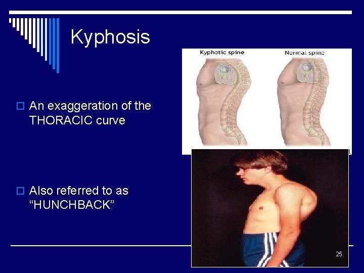 Kyphosis o An exaggeration of the THORACIC curve o Also referred to as “HUNCHBACK”