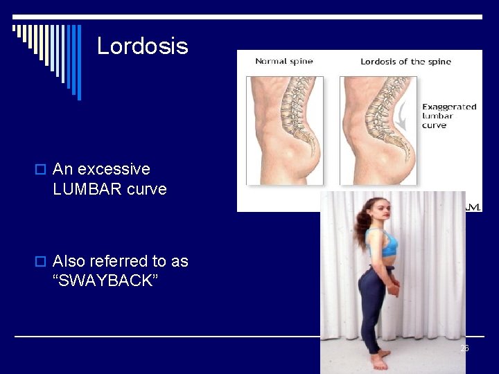 Lordosis o An excessive LUMBAR curve o Also referred to as “SWAYBACK” 26 