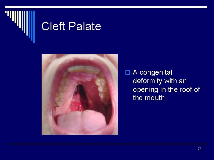 Cleft Palate o A congenital deformity with an opening in the roof of the