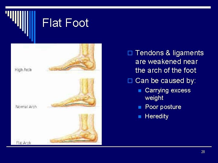 Flat Foot o Tendons & ligaments are weakened near the arch of the foot