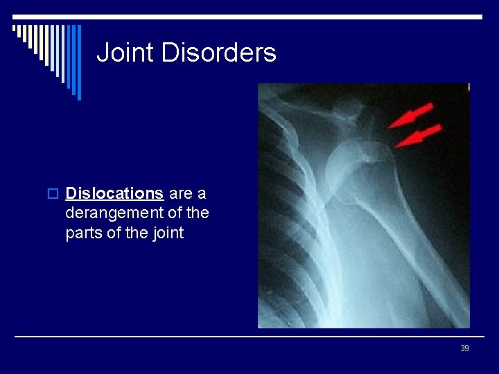 Joint Disorders o Dislocations are a derangement of the parts of the joint 39