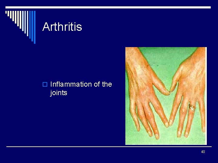 Arthritis o Inflammation of the joints 40 