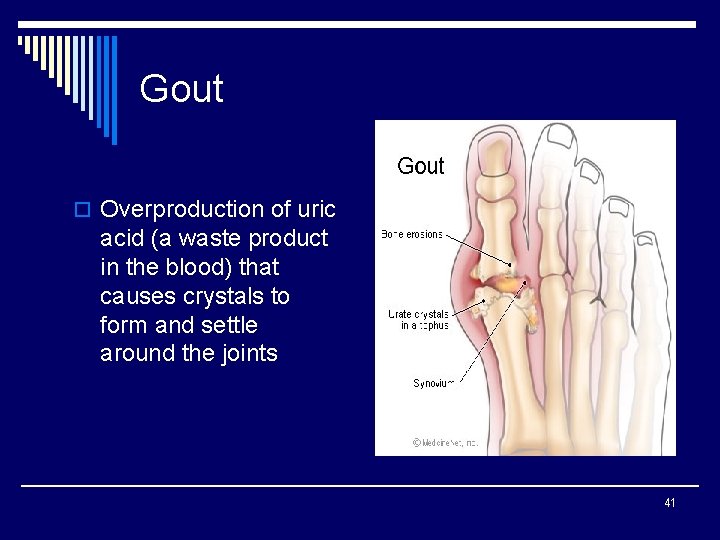 Gout o Overproduction of uric acid (a waste product in the blood) that causes