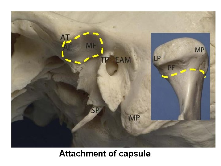 Attachment of capsule 