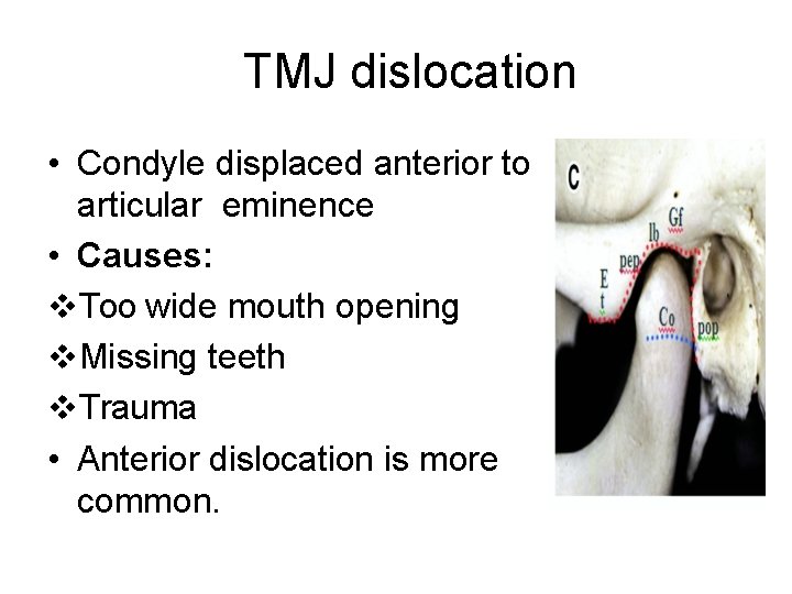 TMJ dislocation • Condyle displaced anterior to articular eminence • Causes: Too wide mouth
