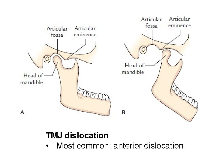 TMJ dislocation • Most common: anterior dislocation 