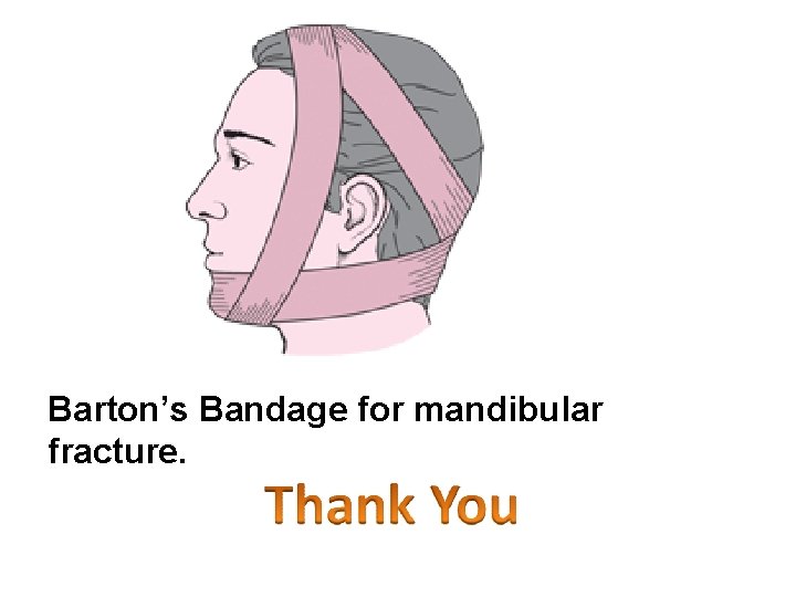 Barton’s Bandage for mandibular fracture. 