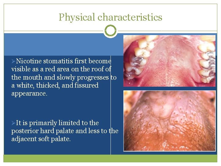 Physical characteristics ØNicotine stomatitis first become visible as a red area on the roof