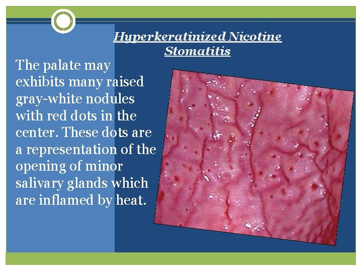 Hyperkeratinized Nicotine Stomatitis The palate may exhibits many raised gray-white nodules with red dots