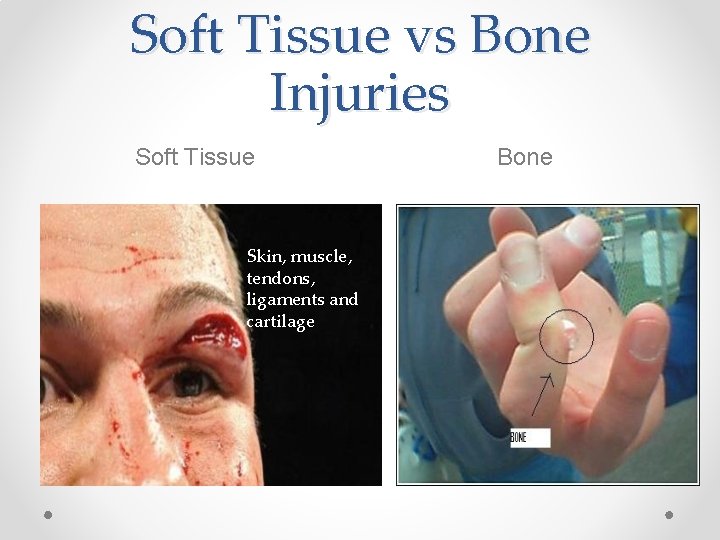 Soft Tissue vs Bone Injuries Soft Tissue Skin, muscle, tendons, ligaments and cartilage Bone