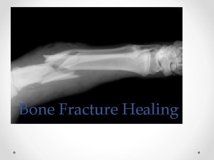 Bone Fracture Healing 