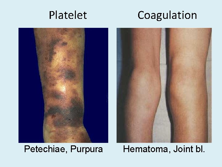 Platelet Petechiae, Purpura Coagulation Hematoma, Joint bl. 