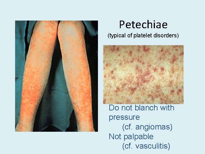 Petechiae (typical of platelet disorders) Do not blanch with pressure (cf. angiomas) Not palpable