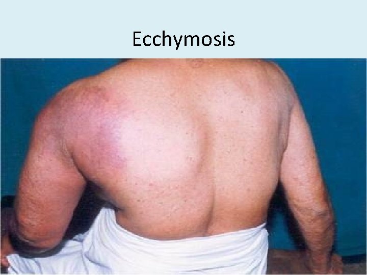 Ecchymosis 