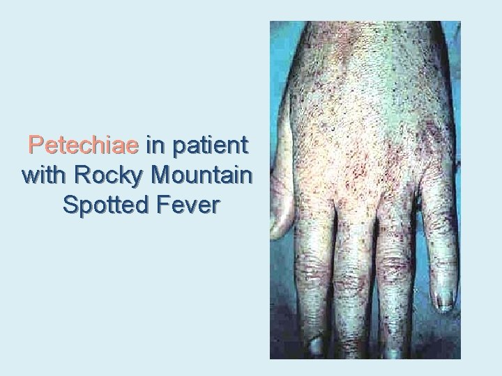 Petechiae in patient with Rocky Mountain Spotted Fever 