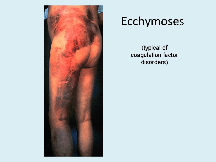 Ecchymoses (typical of coagulation factor disorders) 
