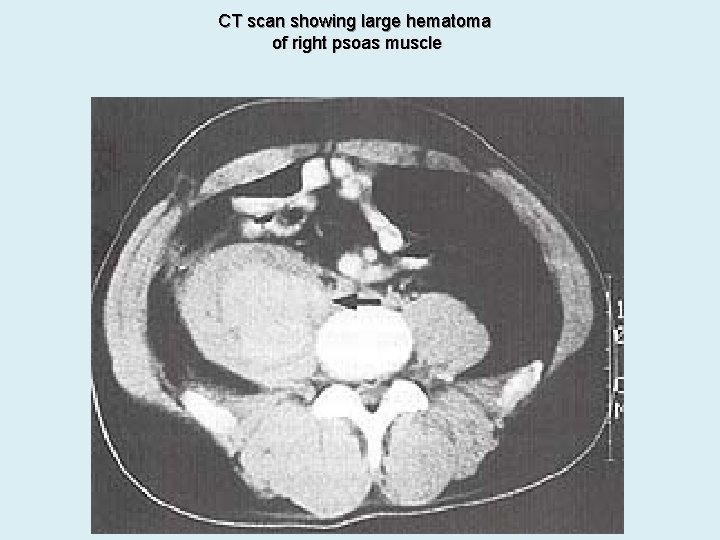 CT scan showing large hematoma of right psoas muscle 