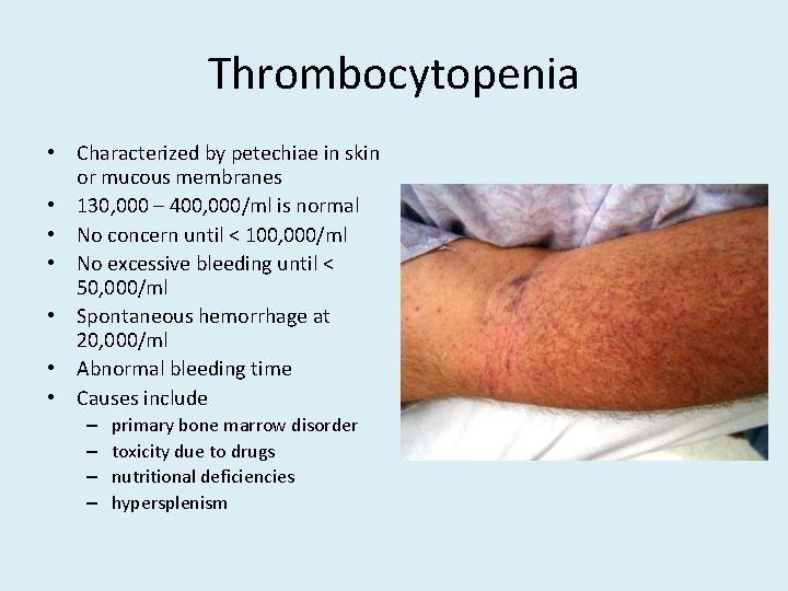 Thrombocytopenia • Characterized by petechiae in skin or mucous membranes • 130, 000 –