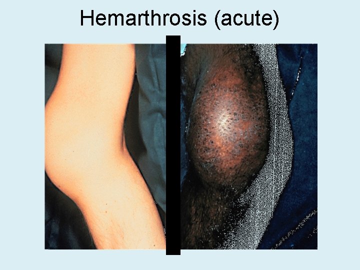 Hemarthrosis (acute) 