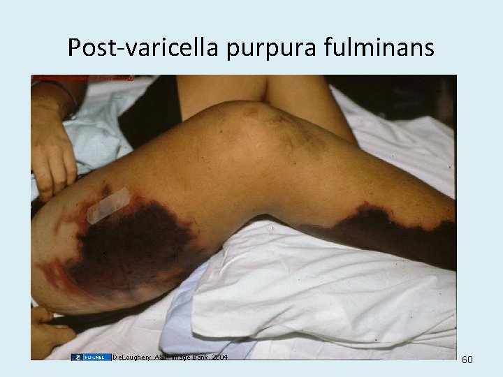 Post-varicella purpura fulminans De. Loughery, ASH Image Bank, 2004 60 