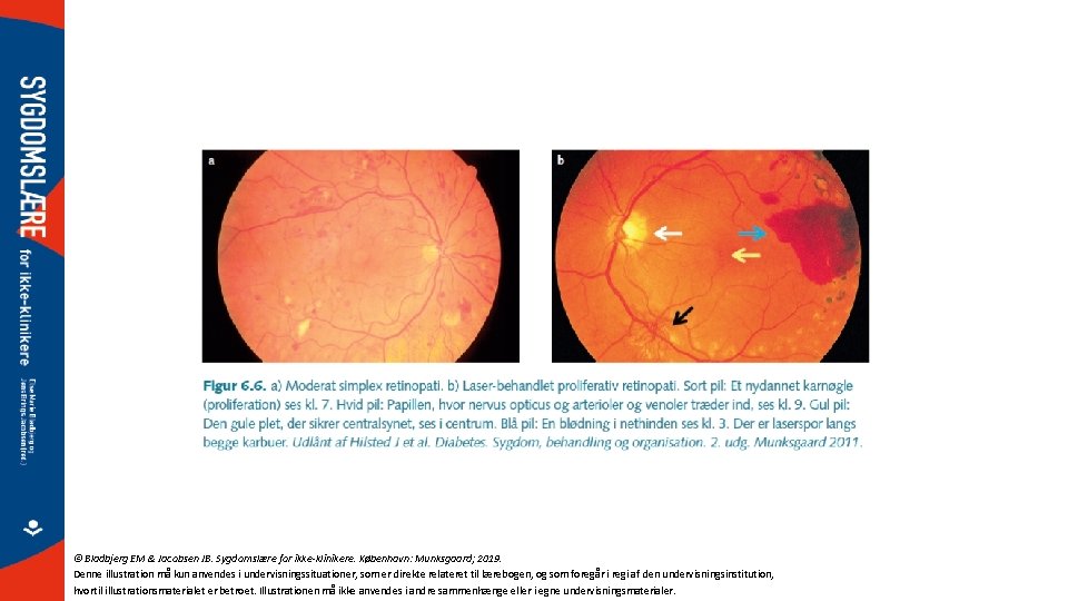 © Bladbjerg EM & Jacobsen JB. Sygdomslære for ikke-klinikere. København: Munksgaard; 2019. Denne illustration