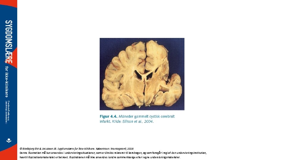© Bladbjerg EM & Jacobsen JB. Sygdomslære for ikke-klinikere. København: Munksgaard; 2019. Denne illustration