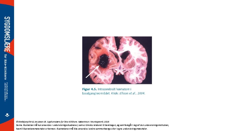 © Bladbjerg EM & Jacobsen JB. Sygdomslære for ikke-klinikere. København: Munksgaard; 2019. Denne illustration