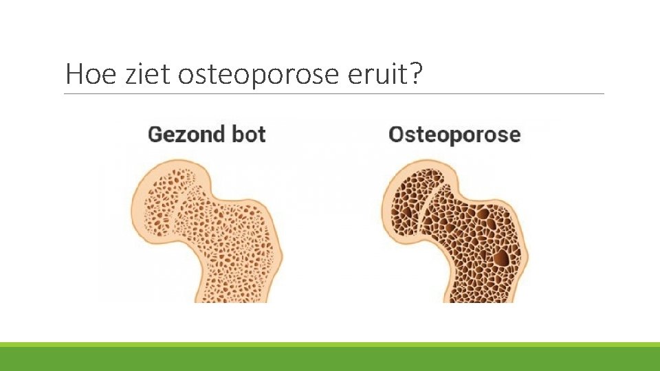 Hoe ziet osteoporose eruit? 
