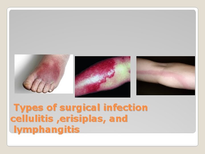 Types of surgical infection cellulitis , erisiplas, and lymphangitis 