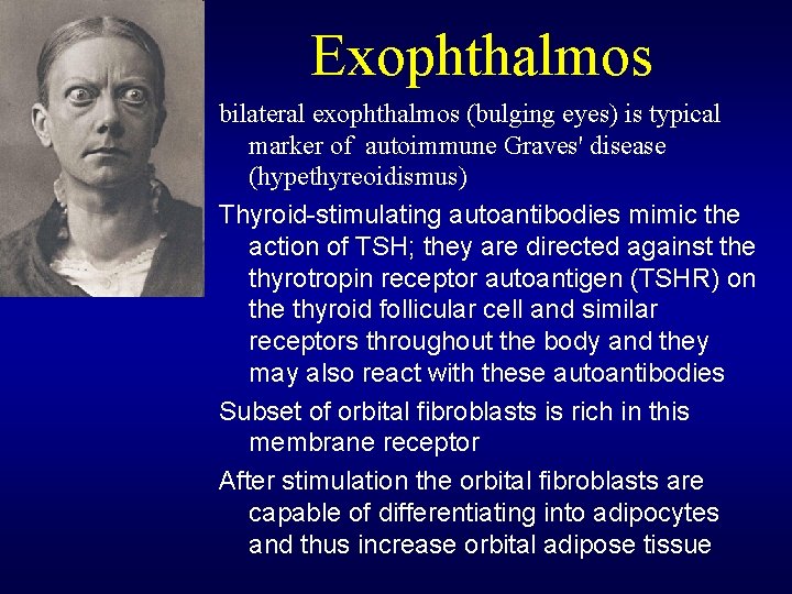 Exophthalmos bilateral exophthalmos (bulging eyes) is typical marker of autoimmune Graves' disease (hypethyreoidismus) Thyroid-stimulating