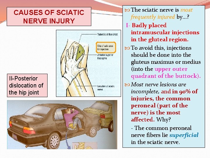 CAUSES OF SCIATIC NERVE INJURY II-Posterior dislocation of the hip joint The sciatic nerve