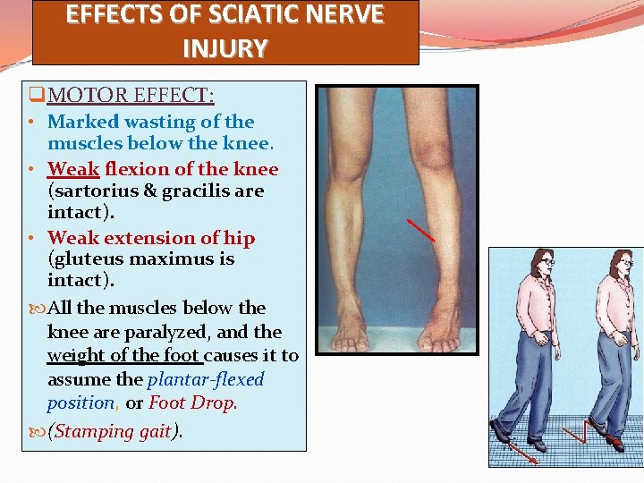 EFFECTS OF SCIATIC NERVE INJURY q MOTOR EFFECT: • Marked wasting of the muscles